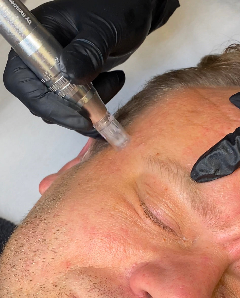 Microneedling